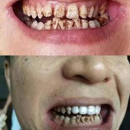 纳米6d美牙教学视频,轻松掌握专业美牙技巧